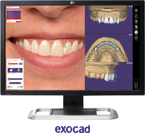 Exocad